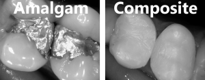 mercury filling replacement